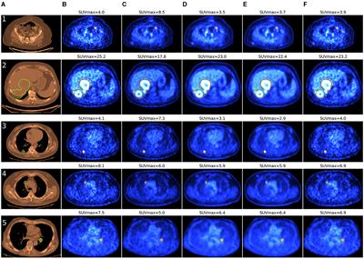 Whole-body PET image denoising for reduced acquisition time